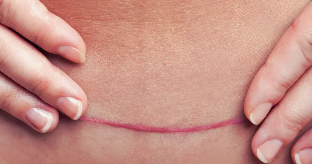 The C-Section Reality: What You’re Not Told The C-Section Reality: What You’re Not Told